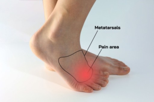 What is Morton's Neuroma?