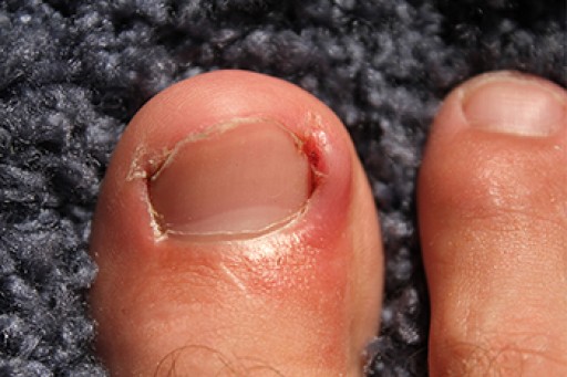 Ingrown Toenail Care